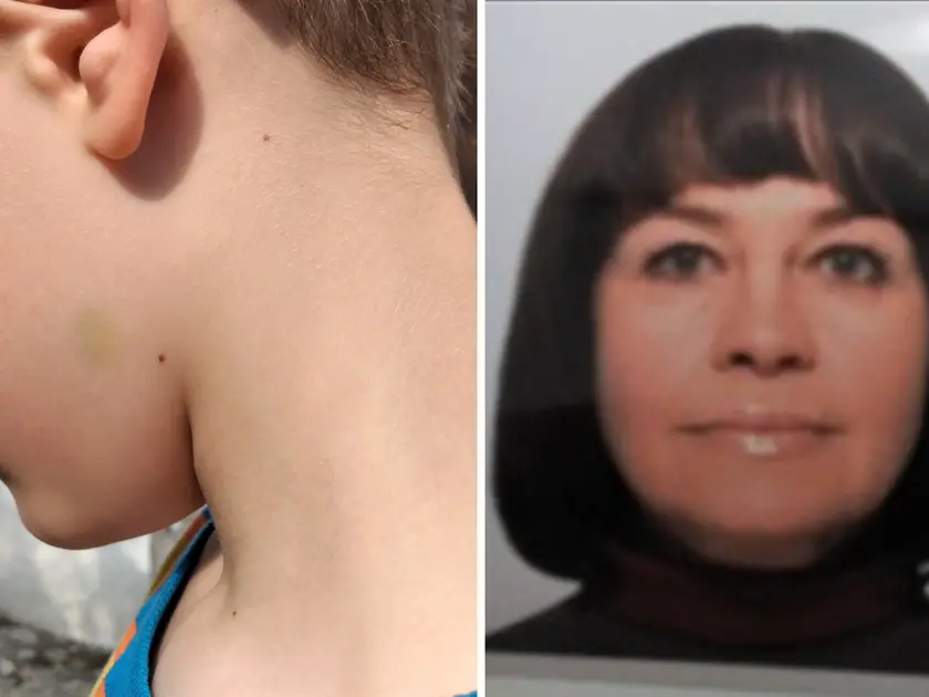 A sinistra il livido sul collo del figlio nell'aggressione di giugno del 2023, a destra Olena Stasiuk