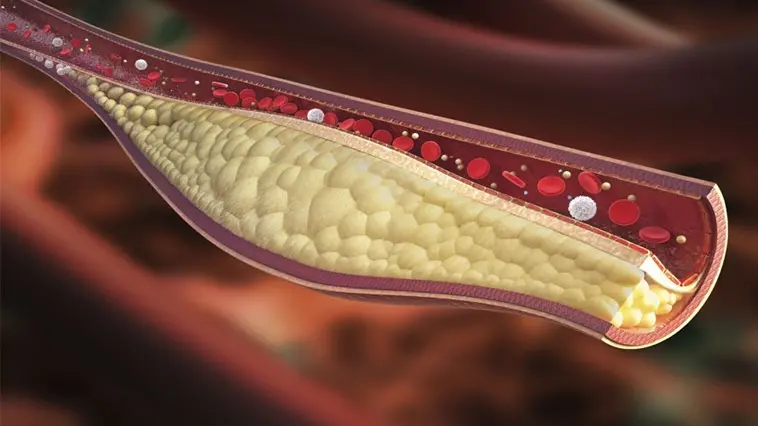 Un'arteria parzialmente ostruita dal colesterolo