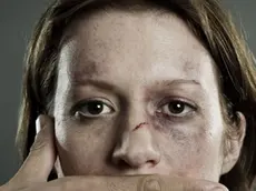 18 Nov 2012 --- Woman with bruises and mouth covered --- Image by © redheadpictures/cultura/Corbis